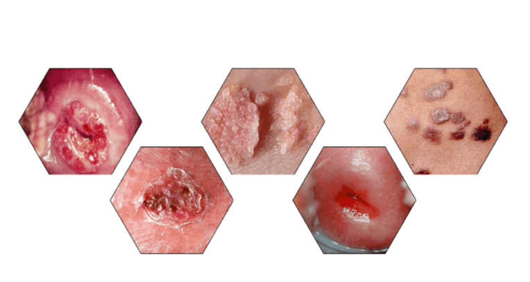 Pourquoi les papillomes sont-ils dangereux