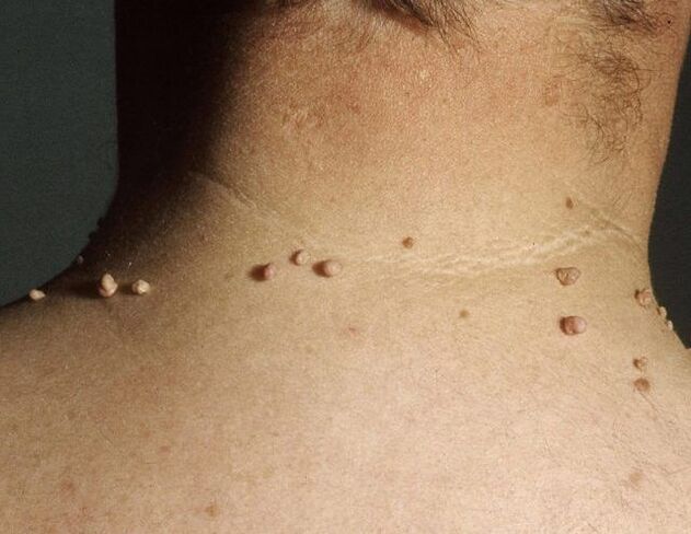 Papillomes sur le cou d'un homme.
