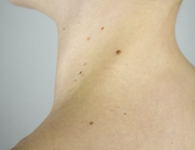 Papillomes sur le cou d'une fille.