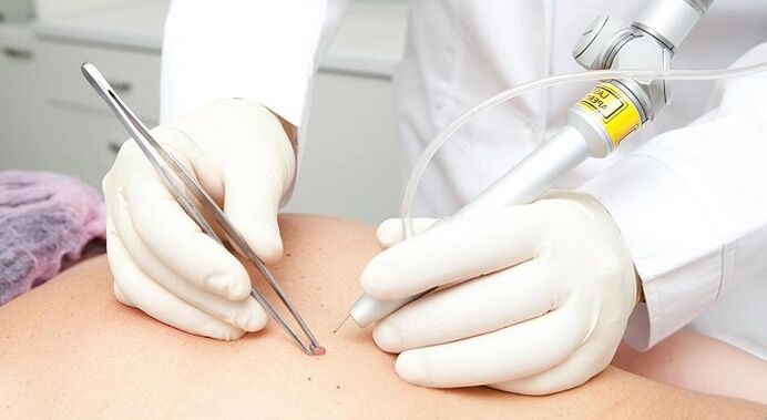 élimination du papillome au laser pour le papillomavirus