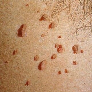 Les papillomes se développent généralement en colonies et peuvent apparaître sur la peau sur tout le corps. 
